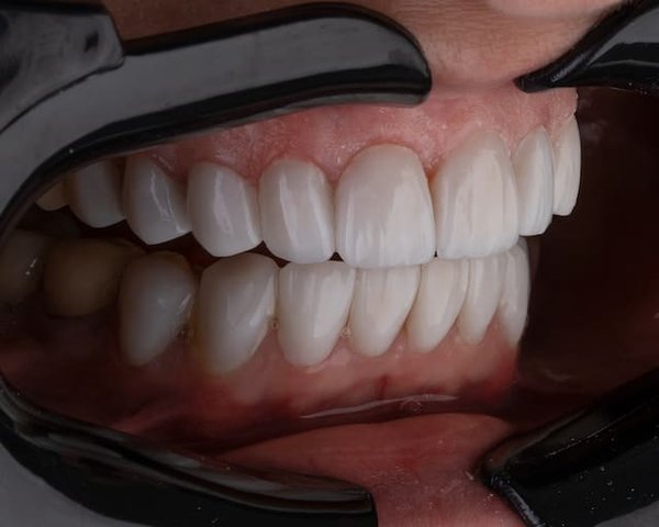 Comment se déroule la pose d'une prothèse dentaire ?